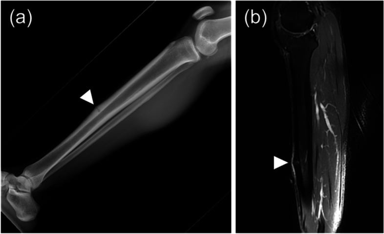 Lateral tibial radiograph with cortical thickening and a fracture line beside STIR MRI showing cortical and marrow signal change