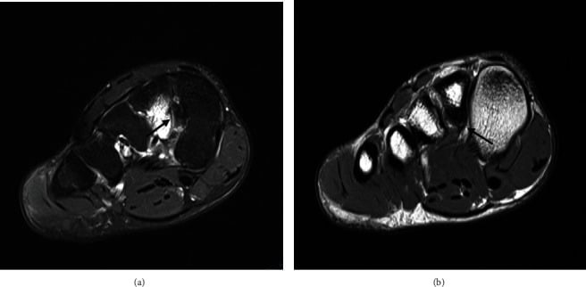 Axial fat-suppressed proton density MRI in a footballer showing oedema involving the interosseous and plantar Lisfranc footprints
