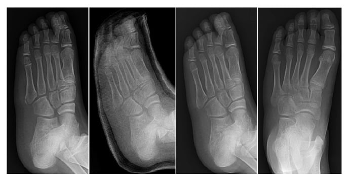Serial radiographs before casting and at one, three and six months during non-operative treatment with early weightbearing