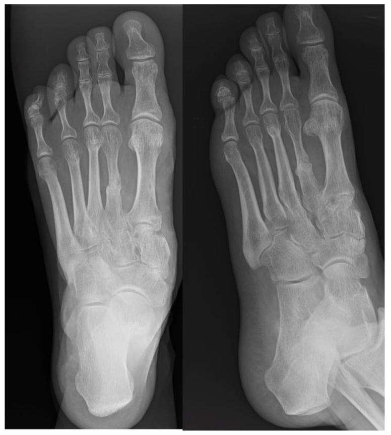 Postoperative weight-bearing radiographs at eight months showing union of a second metatarsal after treatment of a nonunion with restored metatarsal formula