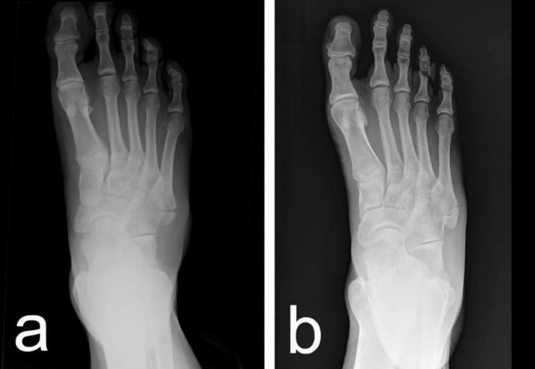 Two radiographs showing a well-corticated accessory ossicle proximal to the fifth metatarsal base