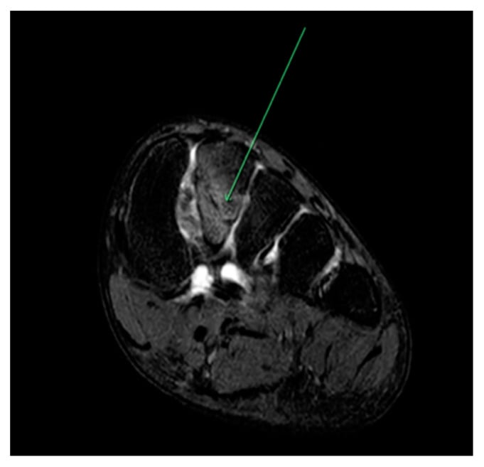 Coronal T2-weighted MRI showing marrow oedema in a second metatarsal stress fracture in a young ballet dancer