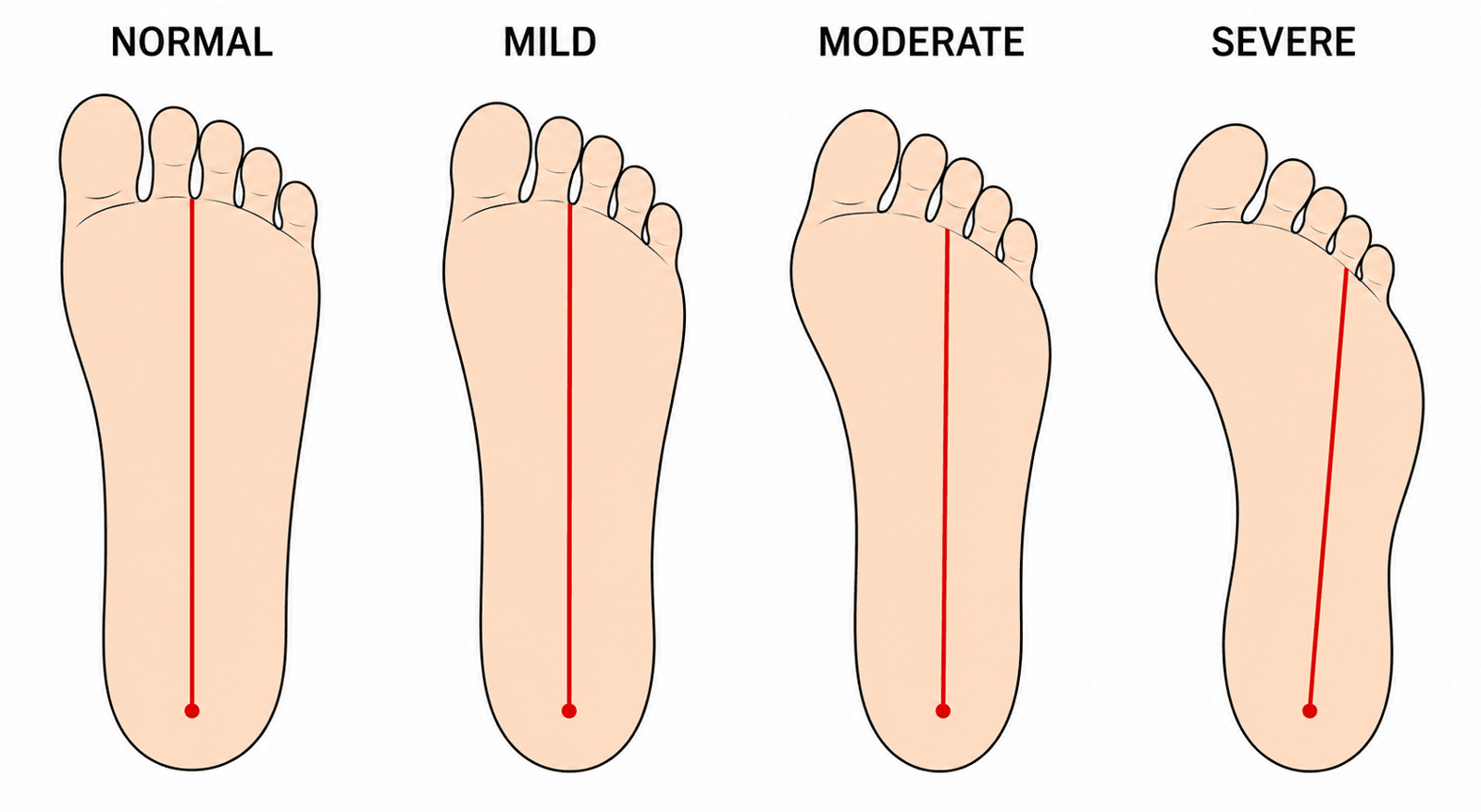 Bleck heel-bisector classification of metatarsus adductus severity, four plantar foot outlines showing the line progressing laterally from normal to severe
