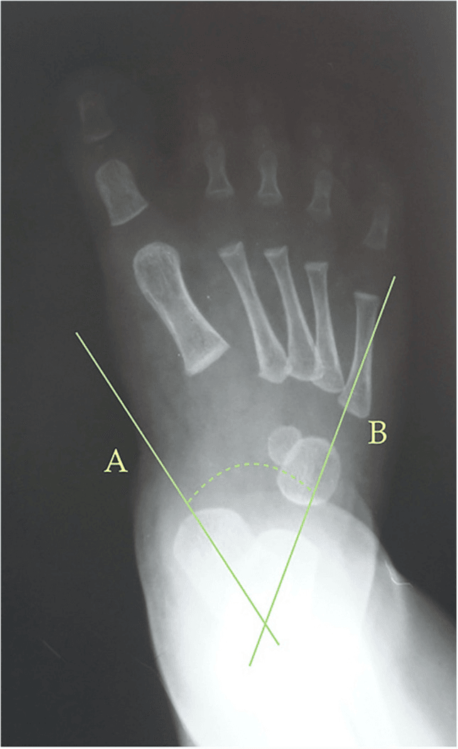 Paediatric foot radiograph annotated with Berg talocalcaneal hindfoot angle