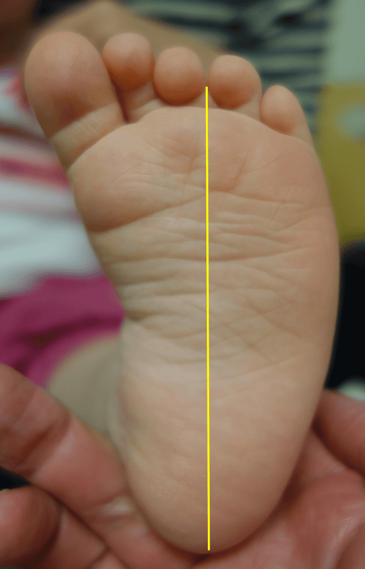 Plantar infant-foot close-up with heel-bisector line demonstrating metatarsus adductus