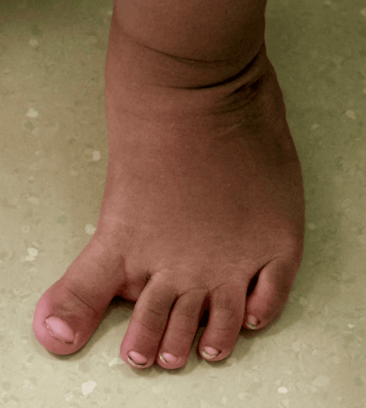Weight-bearing foot on a floor with the great toe deviated medially away from the second toe