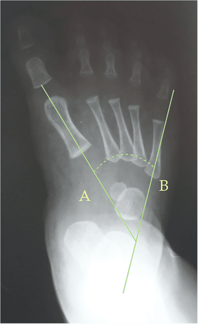 Paediatric dorsoplantar foot radiograph with lines A and B and a dashed arc drawn for Kilmartin's first-ray metatarsus adductus angle