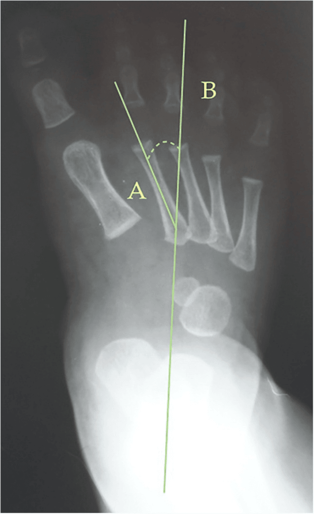 Paediatric foot radiograph annotated with Root metatarsus adductus angle