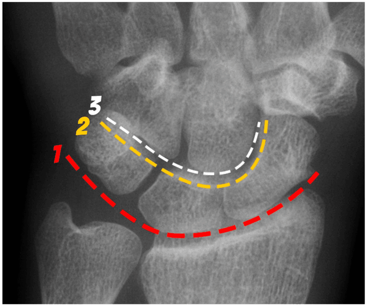 PA wrist radiograph annotated with the three Gilula carpal arcs, numbered 1 to 3
