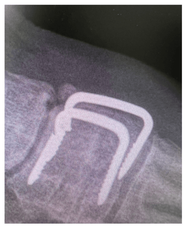 Lateral midfoot radiograph of broken staple metalwork after tarsometatarsal fusion