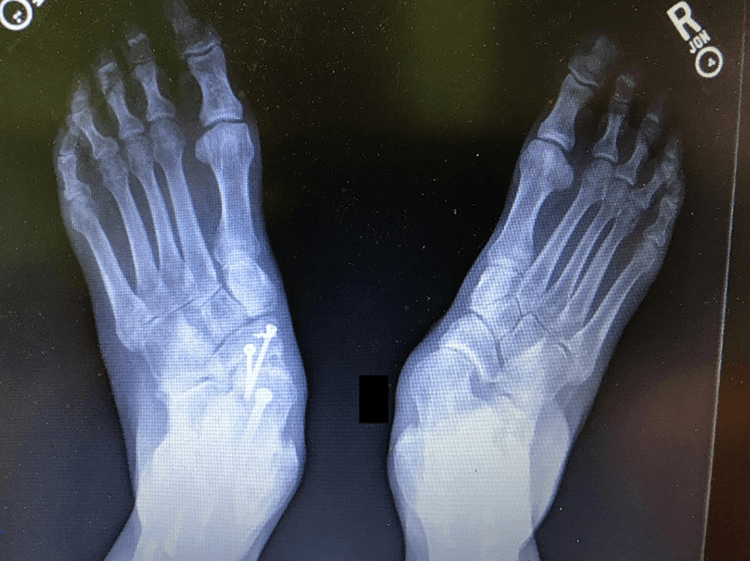 Radiograph of both feet showing a malpositioned arthrodesis, the operated foot on the left of the image with screws in the midfoot