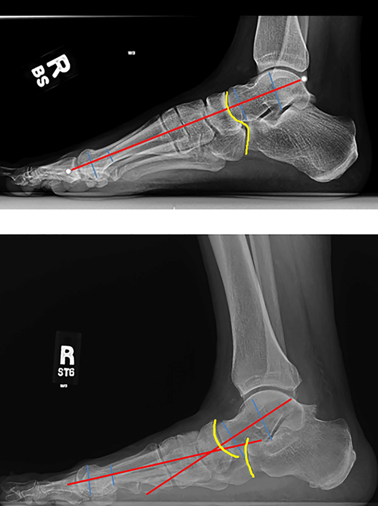 Lateral radiographs of a foot with an intact Meary angle and cyma line (top) and a foot with an abnormal Meary angle and a disrupted cyma line (bottom)