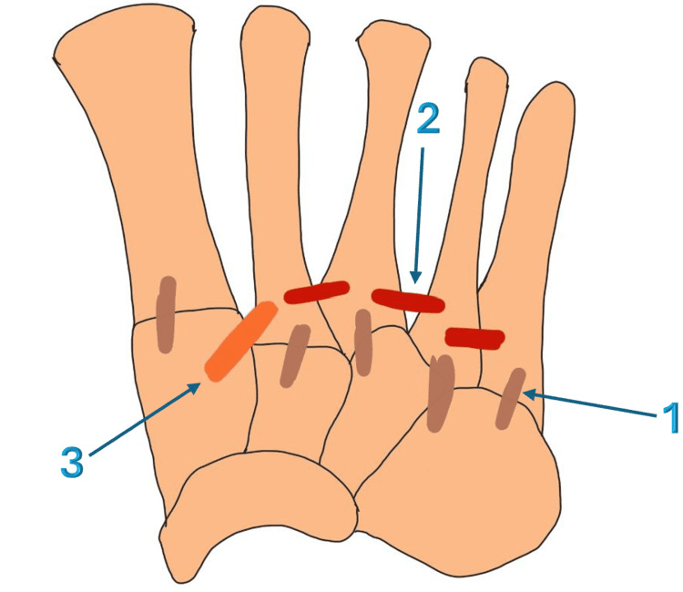 Schematic of the midfoot ligaments with numbered arrows: tarsometatarsal ligaments (1, brown), intermetatarsal ligaments (2, red) and the Lisfranc ligament complex (3, orange)