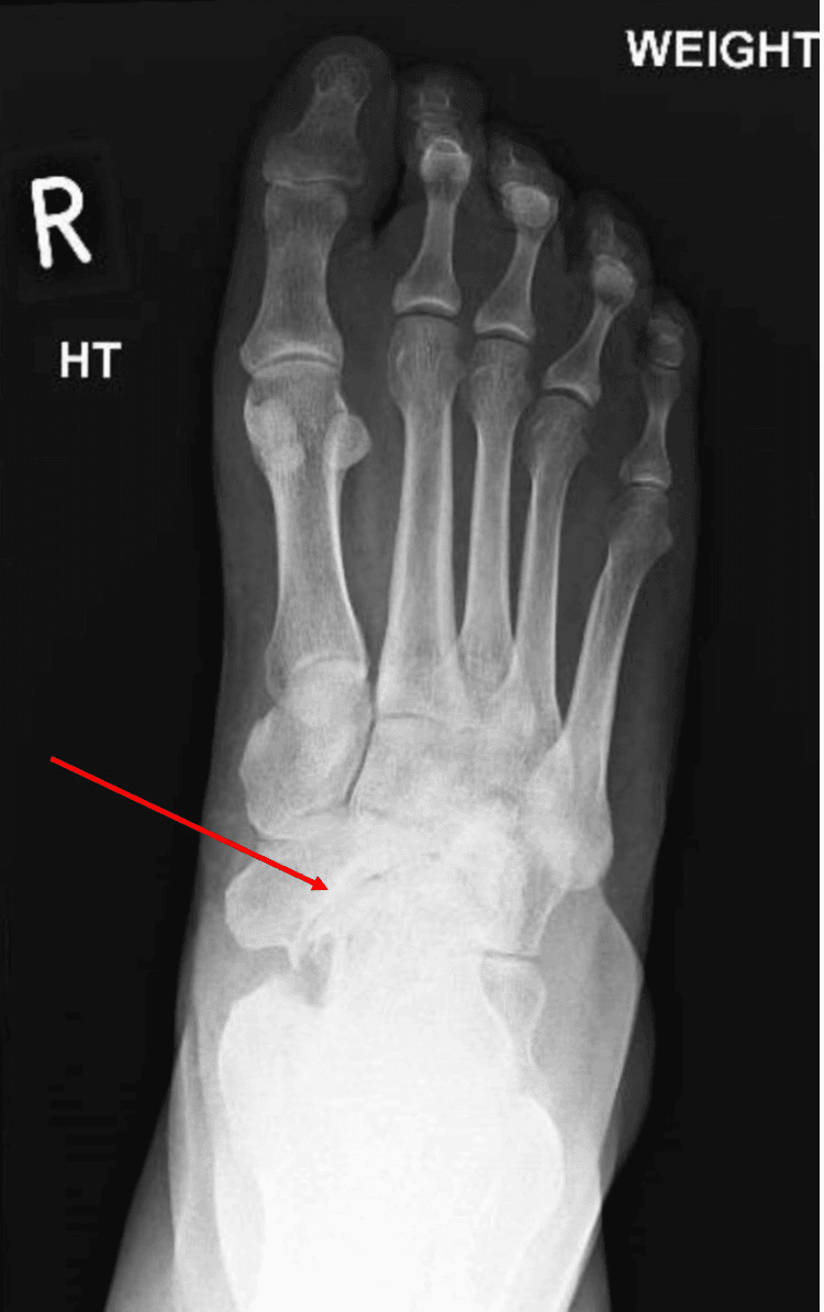 Weight-bearing AP radiograph of a right foot with an arrow marking secondary arthritic change in the medial midfoot