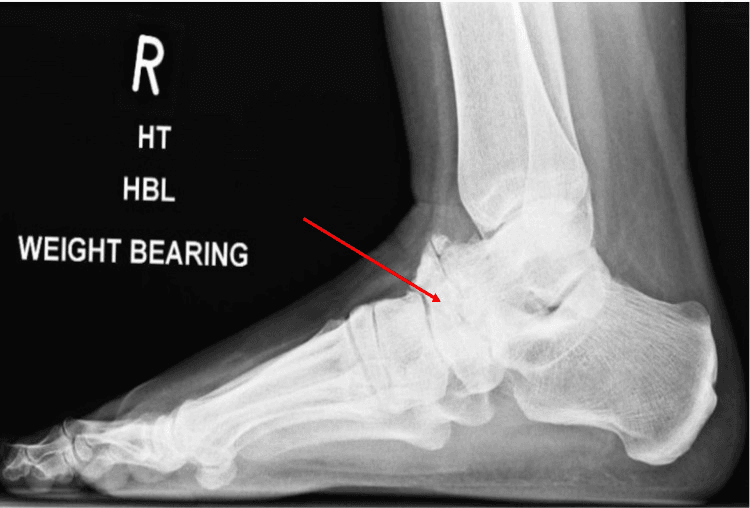 Weight-bearing lateral radiograph of a right foot with an arrow marking navicular collapse and arthritic change