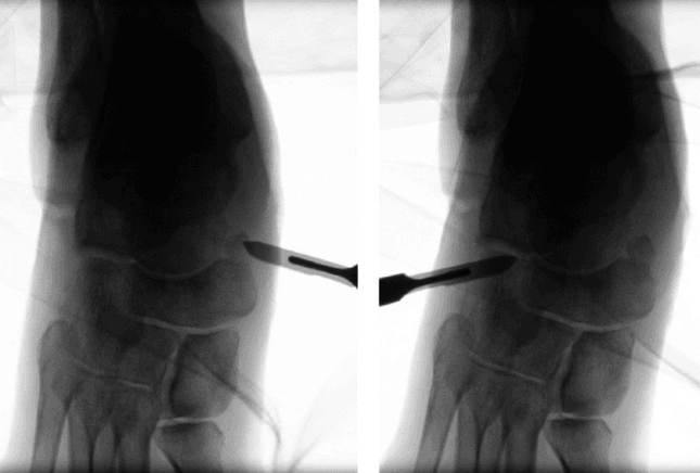 Two intraoperative fluoroscopic images with a blade marking the talonavicular joint line, from the medial side (left) and the dorsolateral side (right)