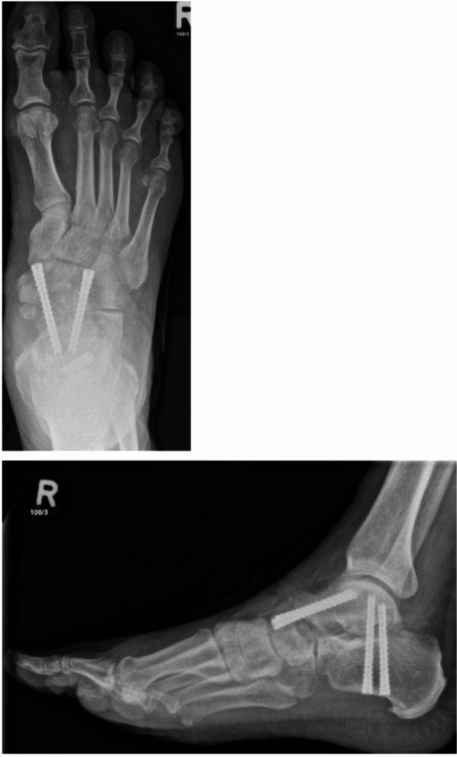 Postoperative dorsoplantar and lateral radiographs of a right foot after talonavicular arthrodesis, with two further screws across the subtalar joint on the lateral view