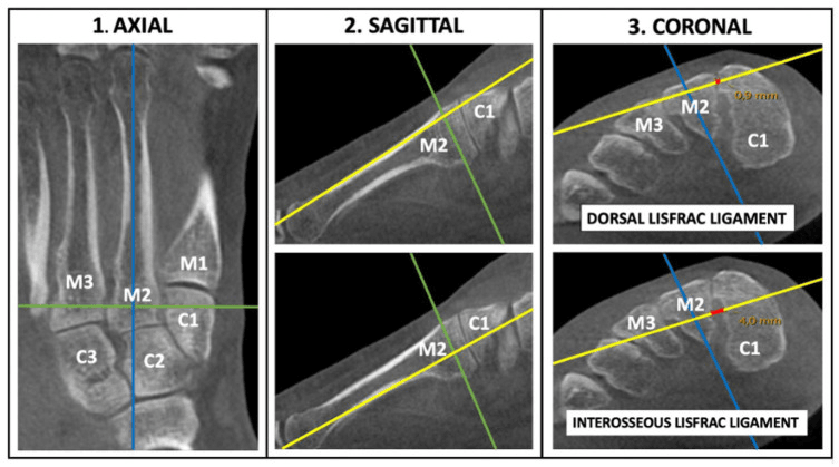Weight-bearing CT axes for dorsal and interosseous Lisfranc diastasis
