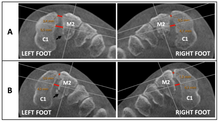 Weight-bearing CT comparison of stable and unstable subtle Lisfranc injuries