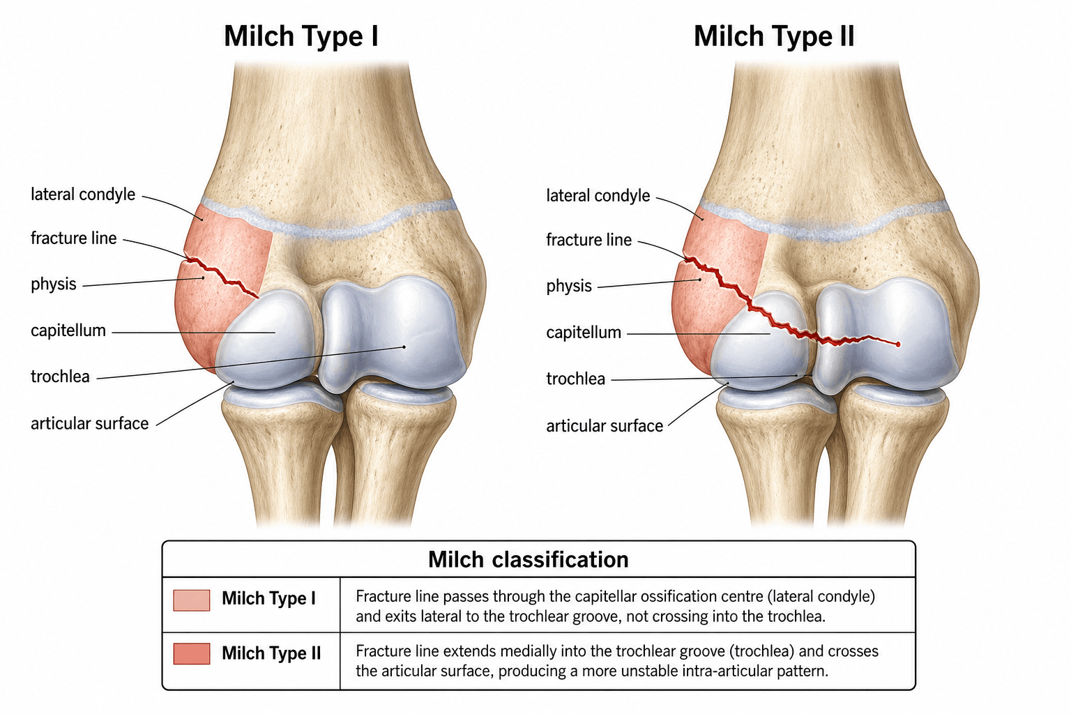 Milch Classification of Lateral Condyle Fractures