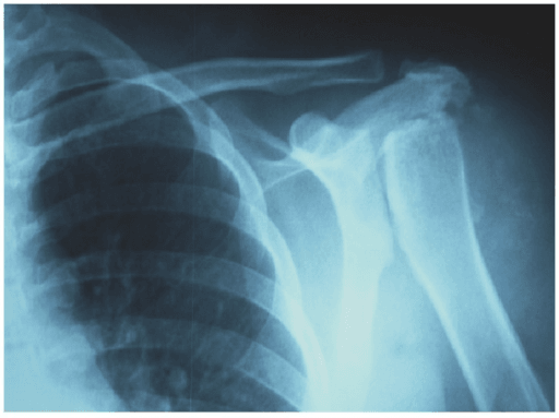 AP shoulder radiograph showing a severely destroyed glenohumeral joint with loss of humeral head contour