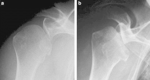 Two AP shoulder radiographs showing progressive flattening and collapse of the humeral head