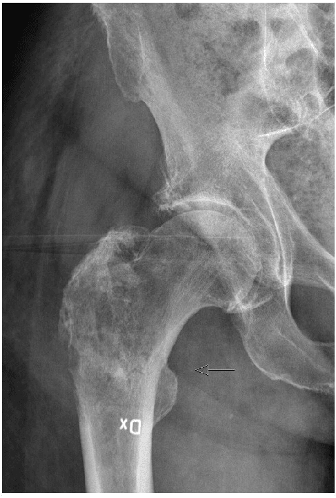 AP radiograph of the proximal femur showing a lytic metastatic lesion in the peritrochanteric region.