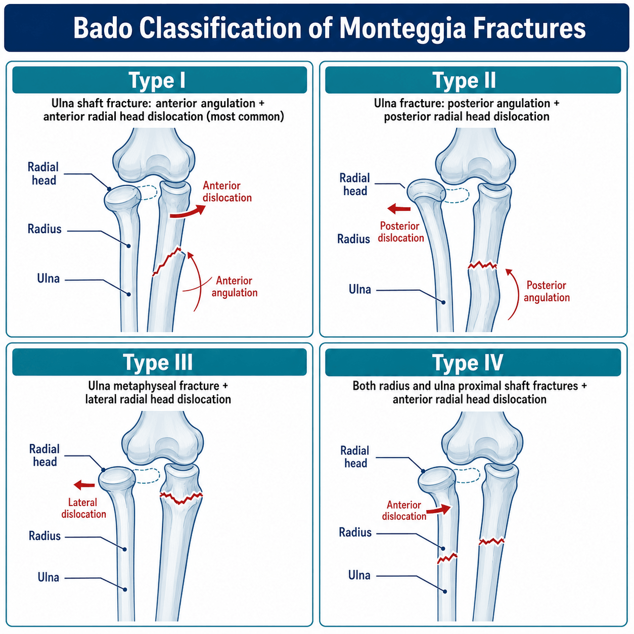 Bado classification of Monteggia fractures