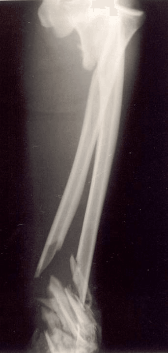 Severe comminuted forearm fracture with the elbow included on the film