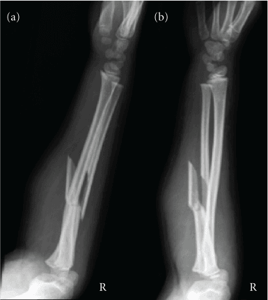 Two-panel Type I Monteggia fracture radiographs