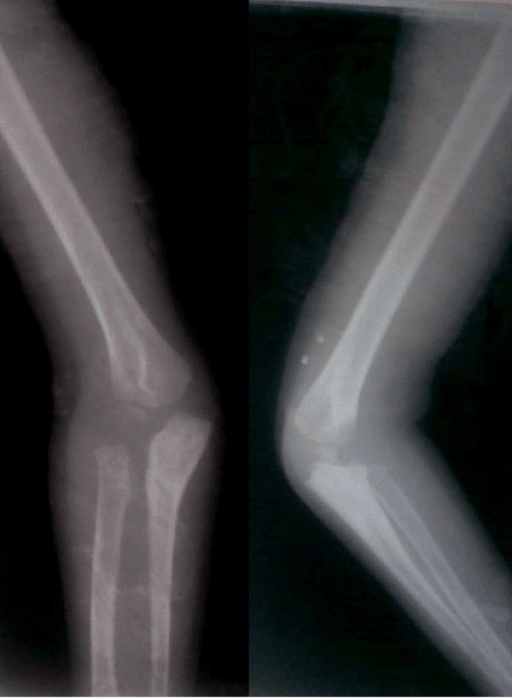 Chronic neglected Monteggia fracture radiographs