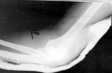 Lateral elbow radiograph showing Monteggia fracture