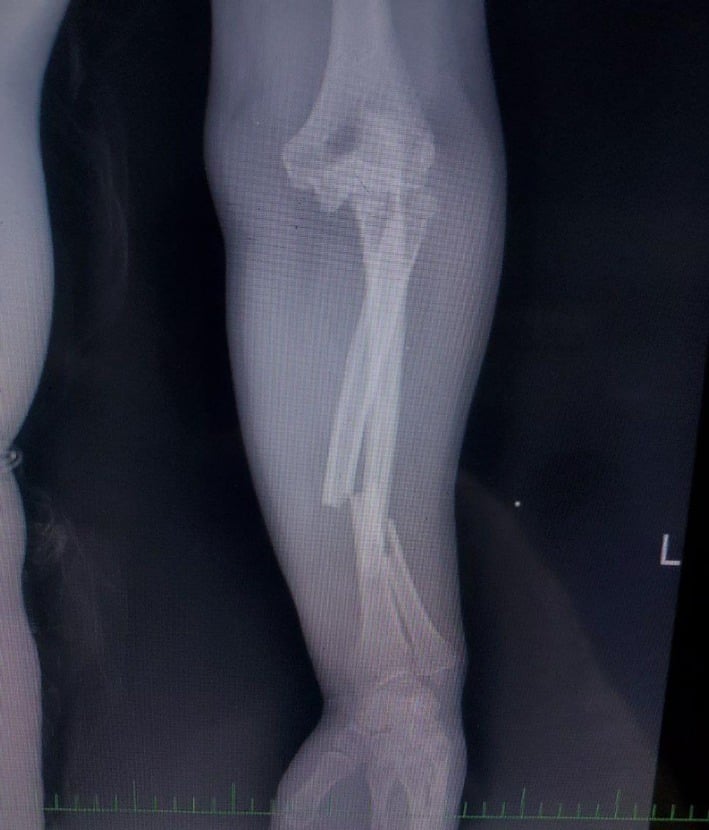 Adult forearm radiograph with a displaced forearm fracture below the elbow, from a case reported as a posterior Monteggia fracture-dislocation
