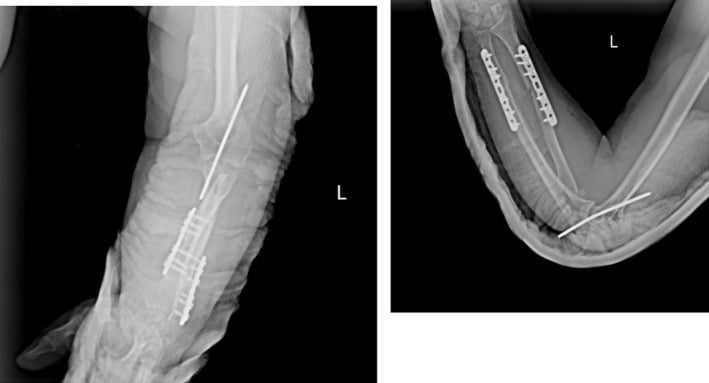 Immediate postoperative radiographs after fixation of a complex adult Monteggia injury, with two forearm plates and a wire