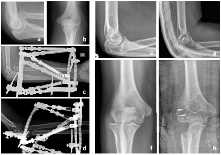 Serial radiographs illustrating salvage procedures for advanced chronic Monteggia dysplasia