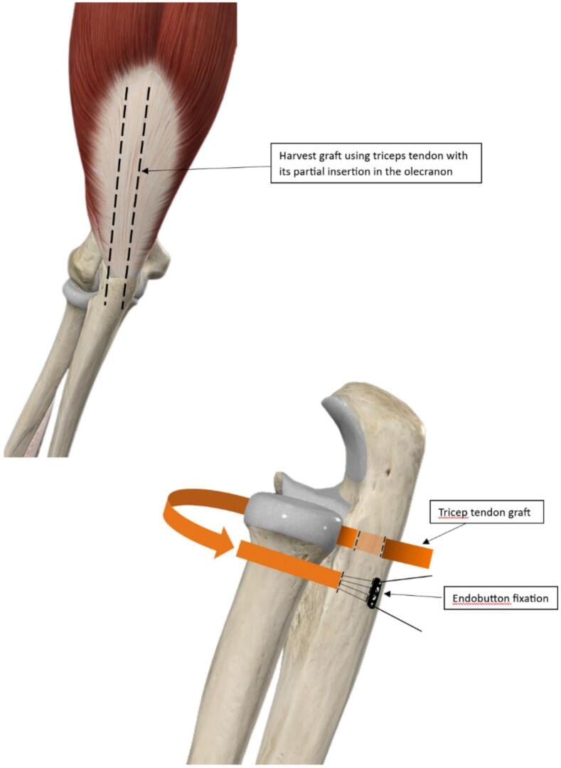 Schematic of Bell-Tawse annular-ligament reconstruction with cortical button fixation