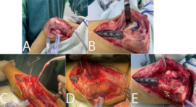 Operative sequence of Bell-Tawse reconstruction through the Speed-Boyd approach