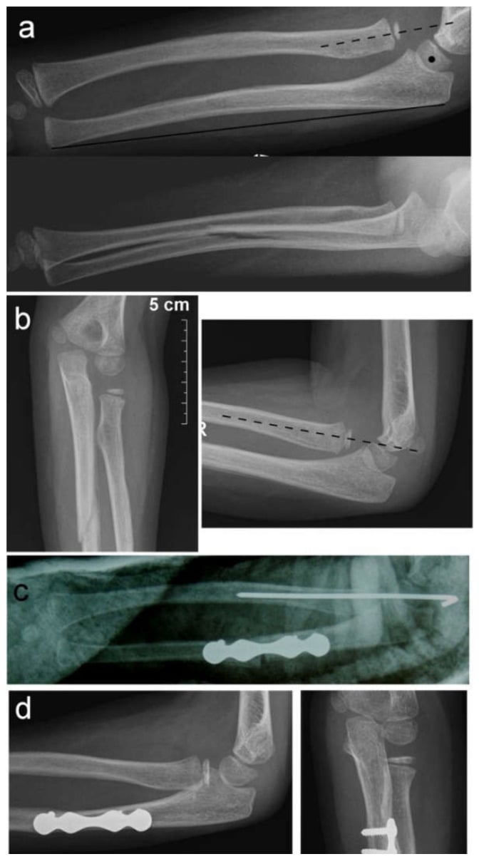 Serial radiographs, panels a to d, showing progression to chronic Monteggia and correction with a plated ulnar osteotomy
