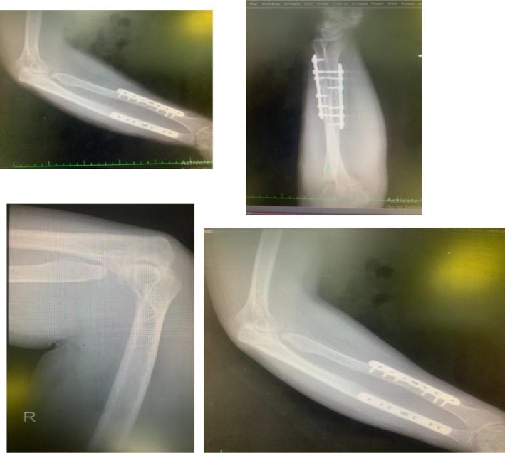 Four-month postoperative radiographs after adult complex Monteggia reconstruction, with plates on both forearm bones and alignment maintained