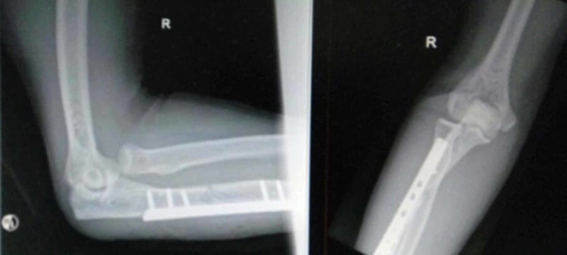 Post-fixation elbow radiographs showing persistent radial-head dislocation despite ulnar plating