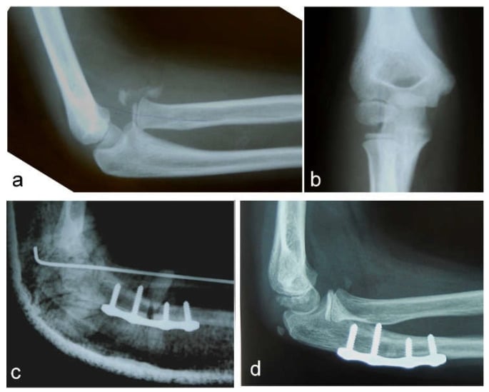Radiographs showing neglected Monteggia injury, corrective ulnar osteotomy and healed reduction