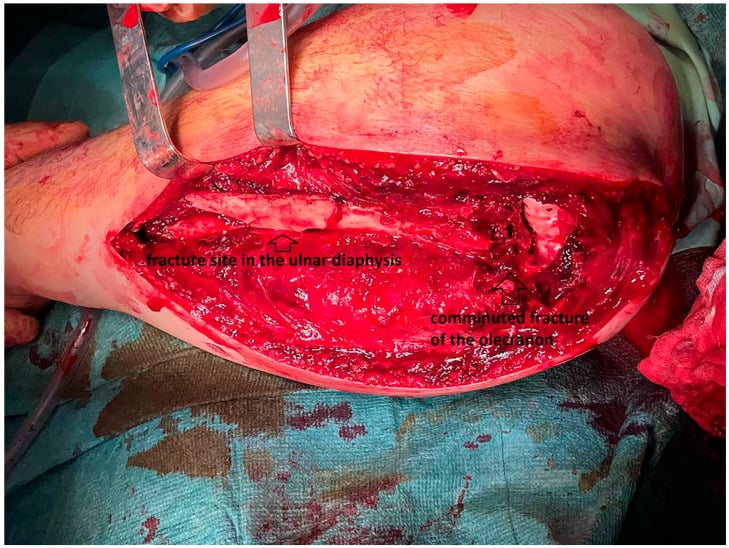 Operative photograph of an exposure of the olecranon and ulnar shaft, labelled with the diaphyseal fracture site and a comminuted olecranon fracture