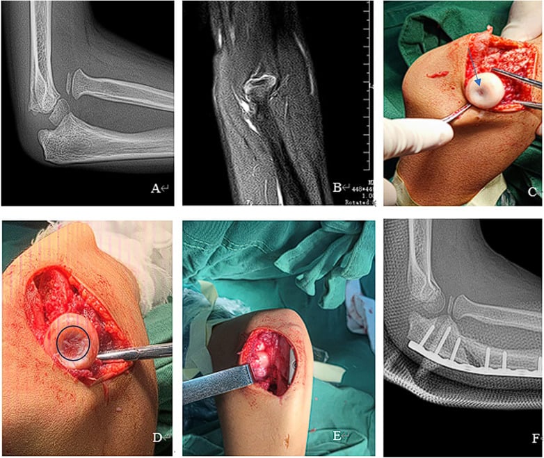 Radiograph MRI and operative sequence showing radial-head dysplasia in missed Monteggia injury