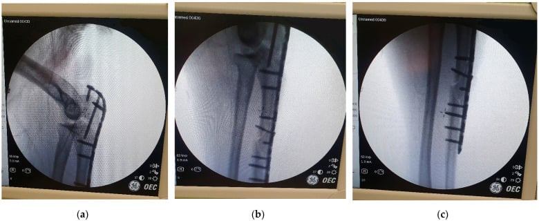 Three fluoroscopic views assessing a long proximal-ulna osteosynthesis construct