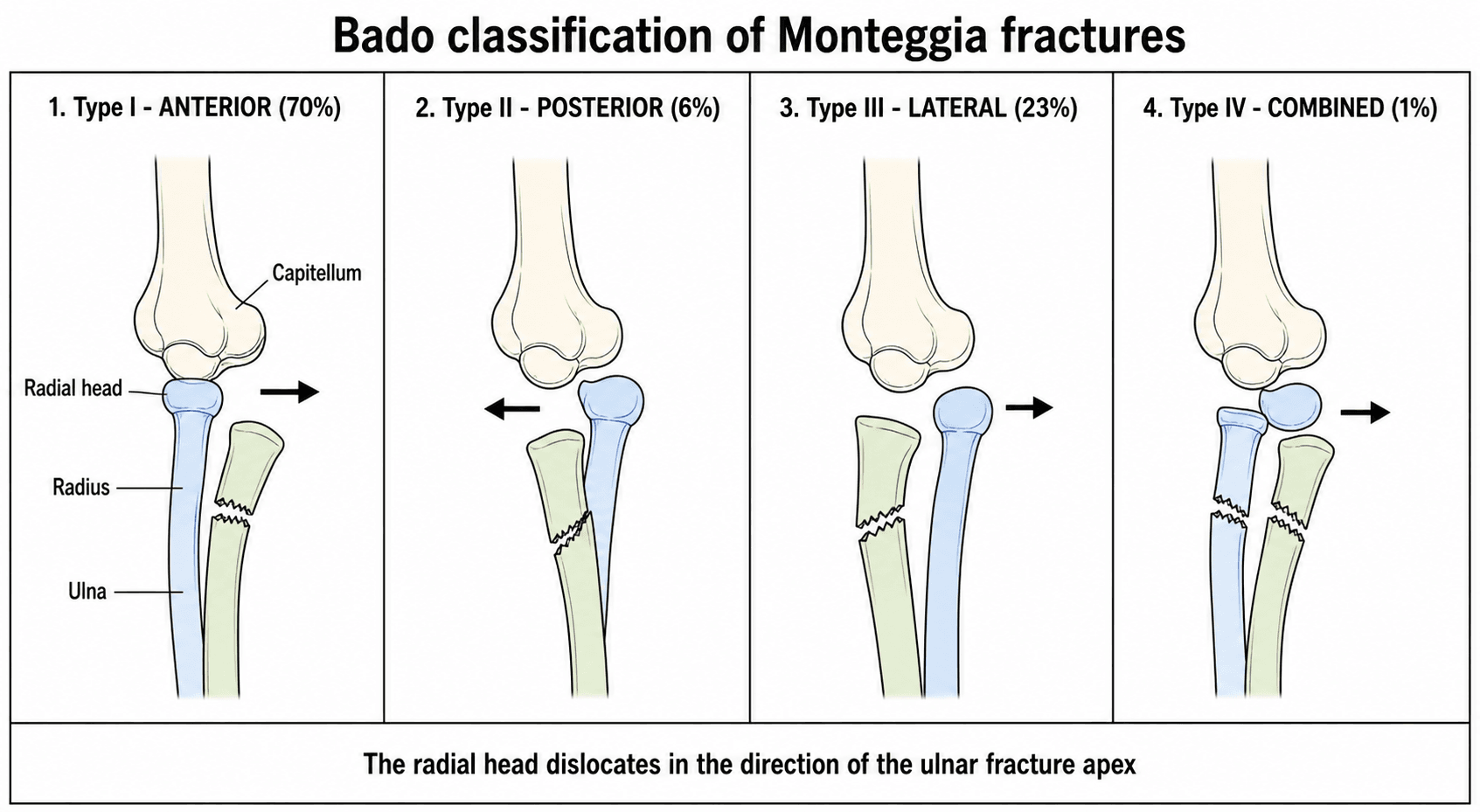Four-panel schematic of the Bado classification of Monteggia fractures showing anterior, posterior, lateral and combined radial head dislocation