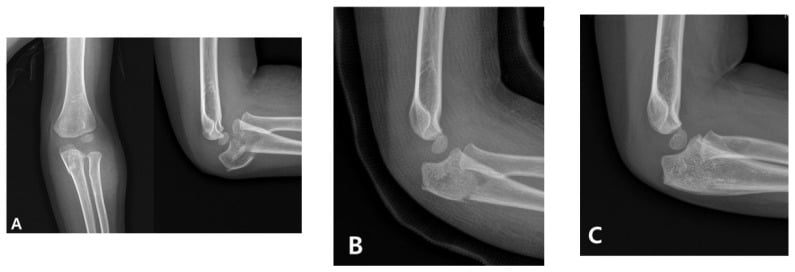 Serial elbow radiographs illustrating the acute Monteggia management pathway before closed reduction, in a cast and after maintained reduction.