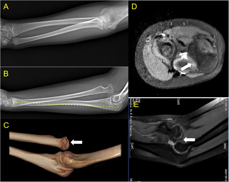 Chronic Monteggia radiographs, CT, MRI and 3D reconstruction showing ulnar bowing and an extra-capsular radial head.