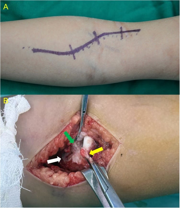 Operative exposure showing fibrous tissue and interposed anterior capsule around a chronically dislocated radial head.