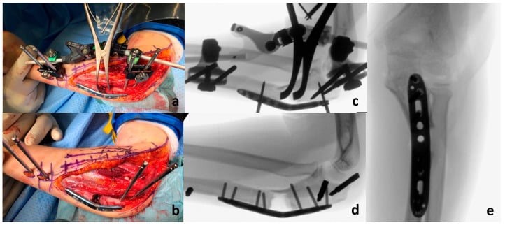 Operative photographs and fluoroscopic views of chronic Monteggia radial-head reduction and definitive ulnar fixation.