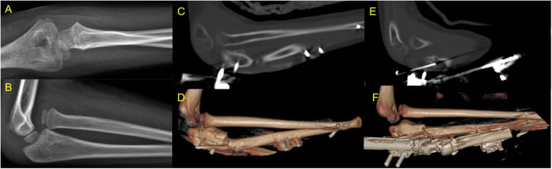 Radiographs and CT showing postoperative reduction followed by chronic Monteggia radial-head redislocation as a reconstruction failure.